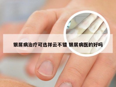 银屑病治疗可选祥云不错 银屑病医的好吗