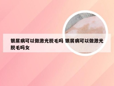 银屑病可以做激光脱毛吗 银屑病可以做激光脱毛吗女