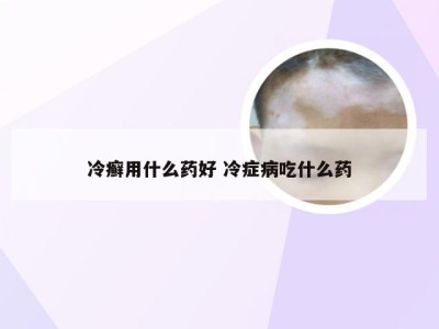 冷癣用什么药好 冷症病吃什么药