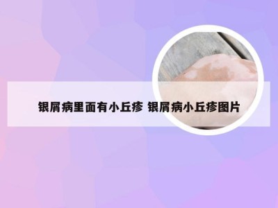 银屑病里面有小丘疹 银屑病小丘疹图片