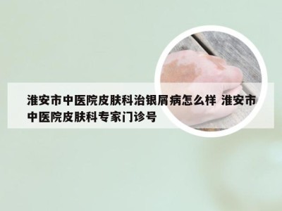 淮安市中医院皮肤科治银屑病怎么样 淮安市中医院皮肤科专家门诊号