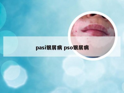 pasi银屑病 pso银屑病