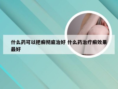 什么药可以把癣彻底治好 什么药治疗癣效果最好