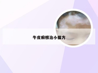 牛皮癣根治小偏方