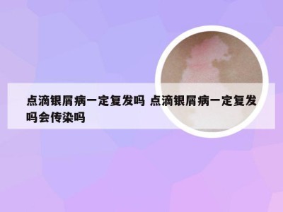 点滴银屑病一定复发吗 点滴银屑病一定复发吗会传染吗