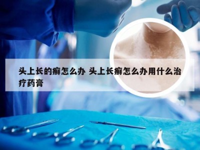 头上长的癣怎么办 头上长癣怎么办用什么治疗药膏