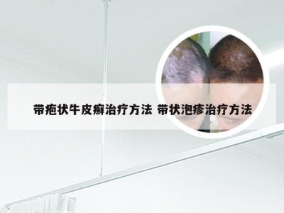 带疱状牛皮癣治疗方法 带状泡疹治疗方法