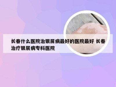 长春什么医院治银屑病最好的医院最好 长春治疗银屑病专科医院