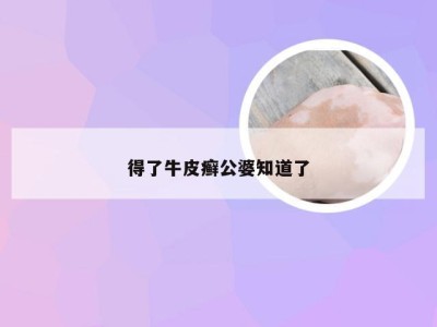 得了牛皮癣公婆知道了