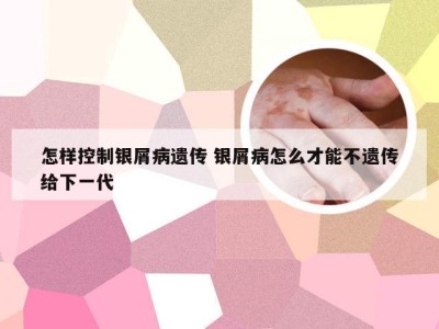 怎样控制银屑病遗传 银屑病怎么才能不遗传给下一代