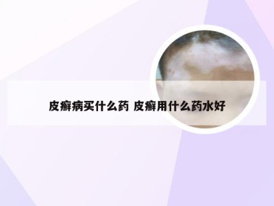 皮癣病买什么药 皮癣用什么药水好