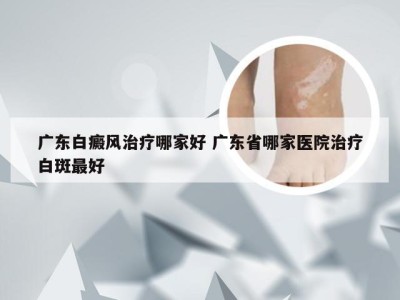 广东白癜风治疗哪家好 广东省哪家医院治疗白斑最好