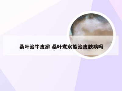 桑叶治牛皮癣 桑叶煮水能治皮肤病吗