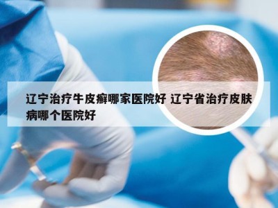 辽宁治疗牛皮癣哪家医院好 辽宁省治疗皮肤病哪个医院好