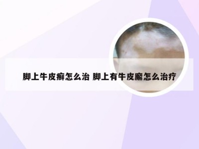 脚上牛皮癣怎么治 脚上有牛皮廨怎么治疗