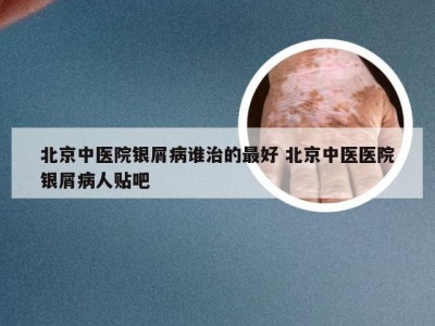 北京中医院银屑病谁治的最好 北京中医医院银屑病人贴吧