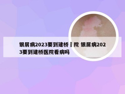 银屑病2023要到建桥醫院 银屑病2023要到建桥医院看病吗