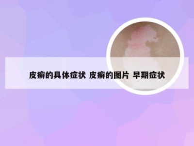 皮癣的具体症状 皮癣的图片 早期症状