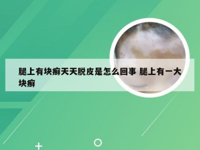 腿上有块癣天天脱皮是怎么回事 腿上有一大块癣