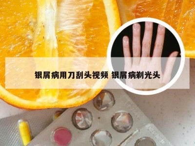 银屑病用刀刮头视频 银屑病剃光头