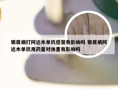 银屑病打阿达木单抗感冒有影响吗 银屑病阿达木单抗用药量对体重有影响吗