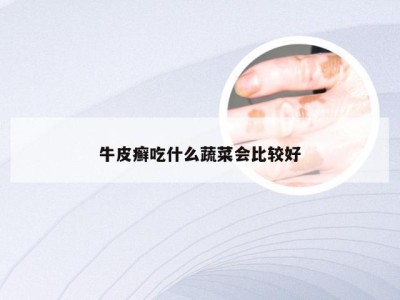 牛皮癣吃什么蔬菜会比较好