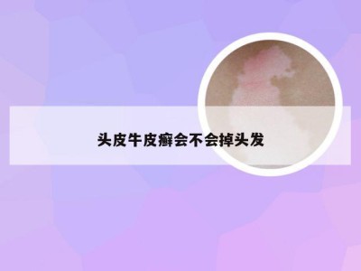 头皮牛皮癣会不会掉头发