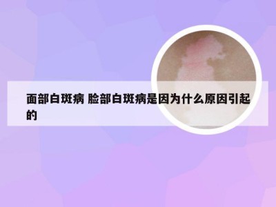 面部白斑病 脸部白斑病是因为什么原因引起的