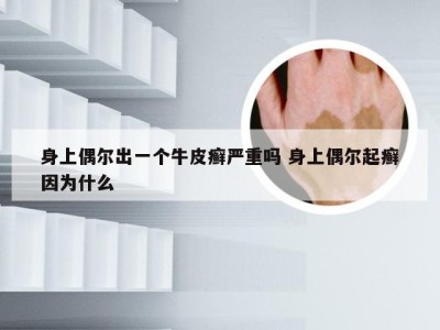 身上偶尔出一个牛皮癣严重吗 身上偶尔起癣因为什么