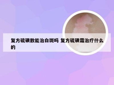 复方硫磺散能治白斑吗 复方硫磺霜治疗什么的