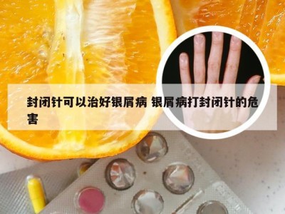 封闭针可以治好银屑病 银屑病打封闭针的危害