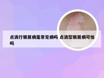 点滴行银屑病是常见病吗 点滴型银屑病可怕吗