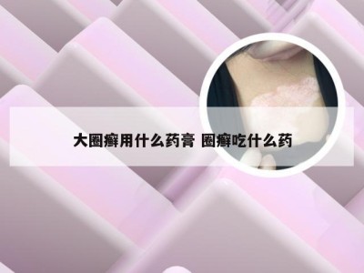 大圈癣用什么药膏 圈癣吃什么药