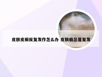 皮肤皮癣反复发作怎么办 皮肤癣总是复发