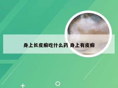 身上长皮癣吃什么药 身上有皮癣