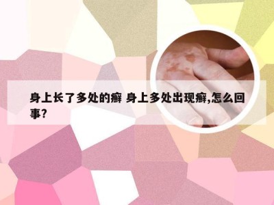 身上长了多处的癣 身上多处出现癣,怎么回事?