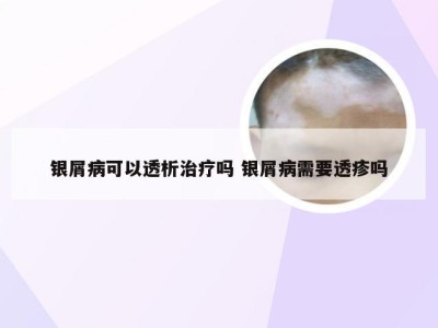 银屑病可以透析治疗吗 银屑病需要透疹吗