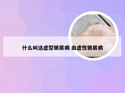 什么叫这虚型银屑病 血虚性银屑病