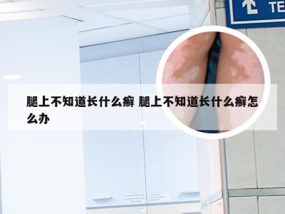 腿上不知道长什么癣 腿上不知道长什么癣怎么办