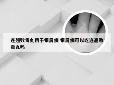 连翘败毒丸用于银屑病 银屑病可以吃连翘败毒丸吗