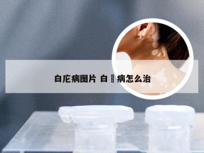 白庀病图片 白疕病怎么治