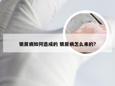 银屑病如何造成的 银屑病怎么来的?