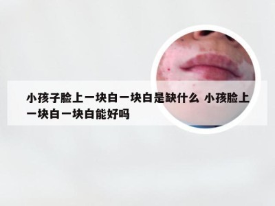 小孩子脸上一块白一块白是缺什么 小孩脸上一块白一块白能好吗