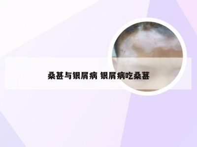 桑甚与银屑病 银屑病吃桑葚