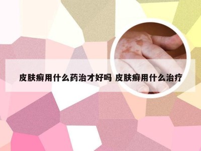 皮肤癣用什么药治才好吗 皮肤癣用什么治疗