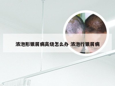 浓泡形银屑病高烧怎么办 浓泡行银屑病