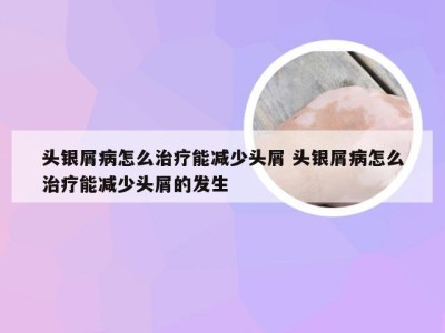 头银屑病怎么治疗能减少头屑 头银屑病怎么治疗能减少头屑的发生