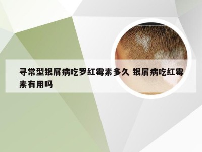 寻常型银屑病吃罗红霉素多久 银屑病吃红霉素有用吗