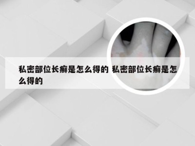 私密部位长癣是怎么得的 私密部位长癣是怎么得的