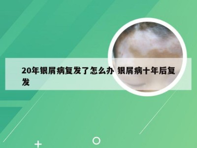 20年银屑病复发了怎么办 银屑病十年后复发